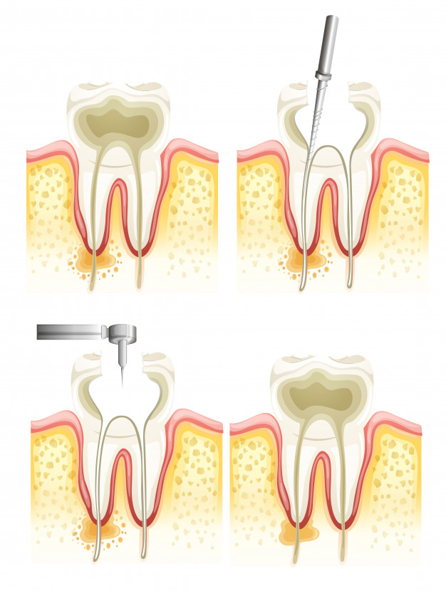 root-canal-process_1308-4753