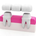 dental-bridge-concept-dental-crown-tooth_241146-607