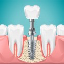 dental-surgery-tooth-implant-cut-illustration-healthy-teeth-dental-implant-stomatology-poster_80590-7852