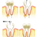 root-canal-process_1308-4753